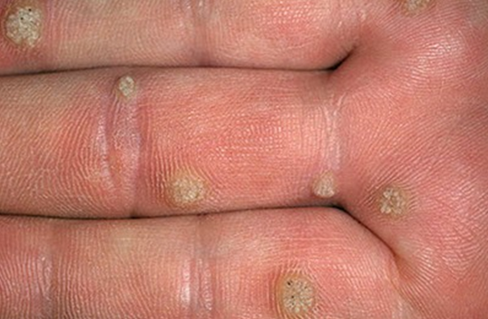prosto zamechatelnoe papillomi virus perekis i kogda Перекись и вирус папилломы фото